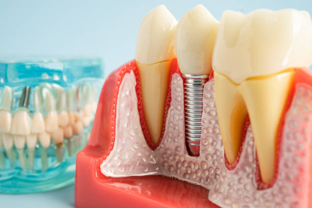 Best Wisdom Tooth Removal  in Valle Vista, CA